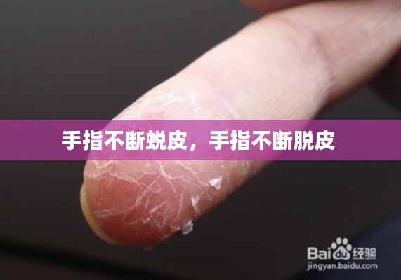 手指不断蜕皮，手指不断脱皮 