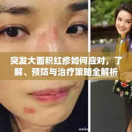 突发大面积红疹如何应对,了解、预防与治疗策略全解析
